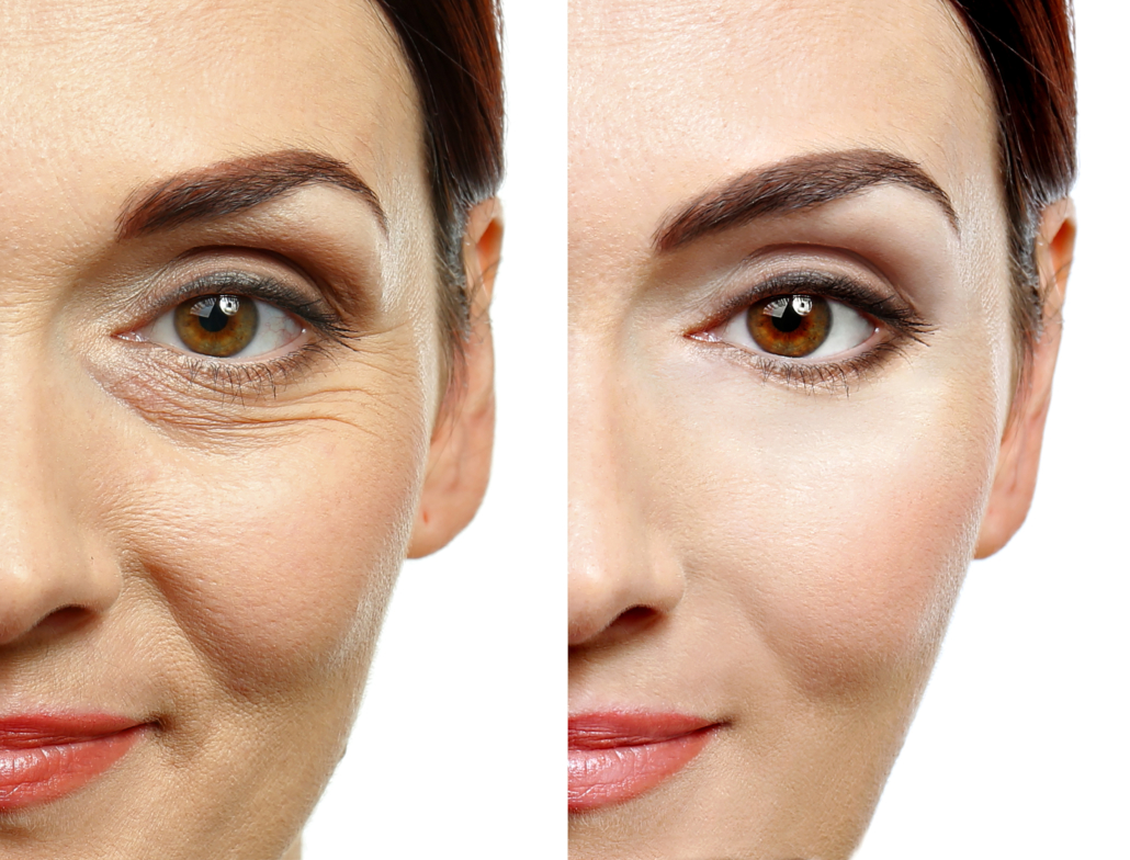 Botox/Xeomin-Complete-Eyes